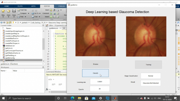 GlaucomaDetection using CNN and Matlab 2