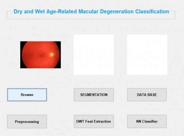 Dry and Wet Age Related Macular Degeneration Classification using OCT Images and Deep Learning 2