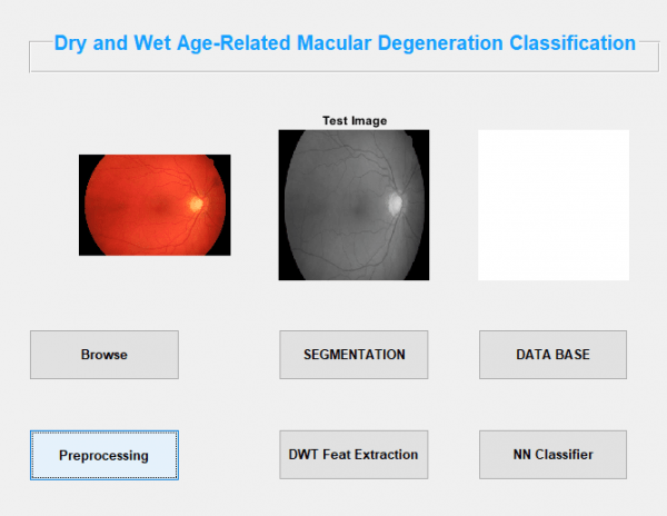 Dry and Wet Age Related Macular Degeneration Classification using OCT Images and Deep Learning 3