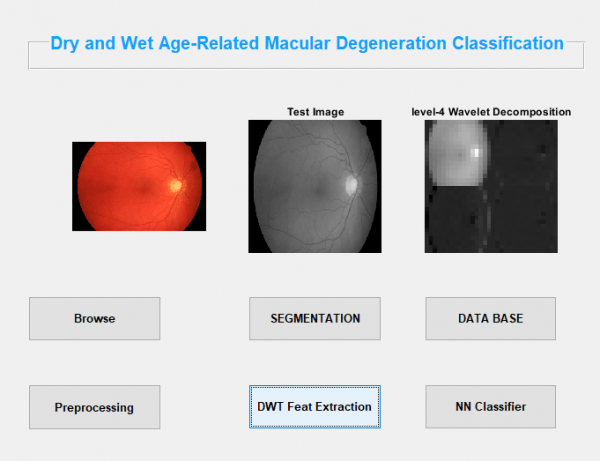 Dry and Wet Age Related Macular Degeneration Classification using OCT Images and Deep Learning 5