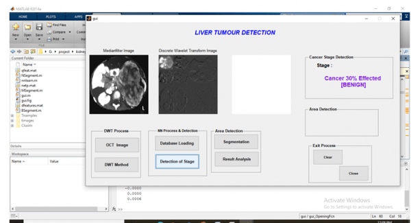 Liver Tumor Detection using Neural Networks and Matlab 4