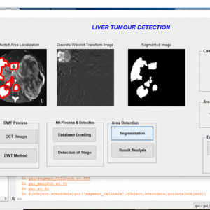 Liver Tumor Detection using Neural Networks and Matlab 6