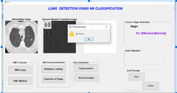 Lung Cancer detection Using Matlab 4