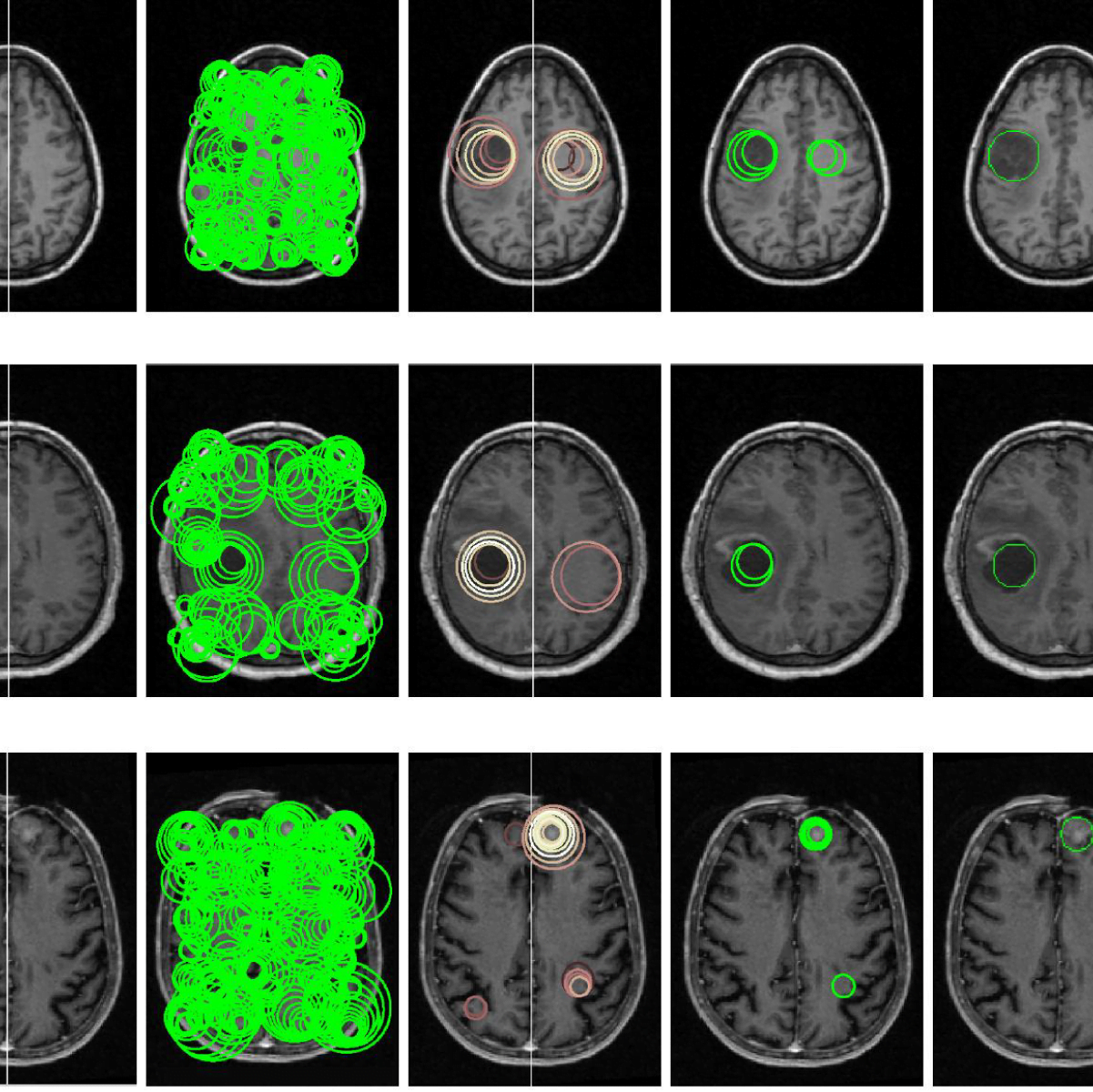 3 D video based brain tumor detection