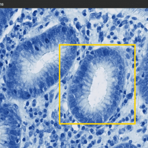 Detecting Diseases in Gastrointestinal Biopsy Images using deep learningA