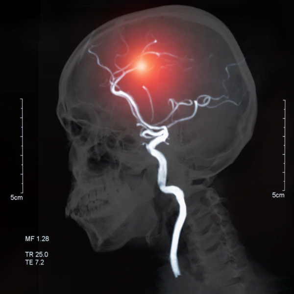 Intelligent brain hemorrhage diagnosis using deep learning