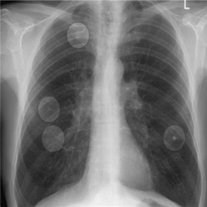 Lung Nodule Detection in X ray Images using Image Processing