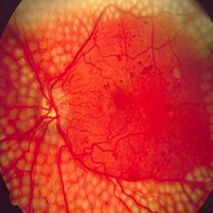 Matlab code for optic disk detection in Diabetic retinopathy