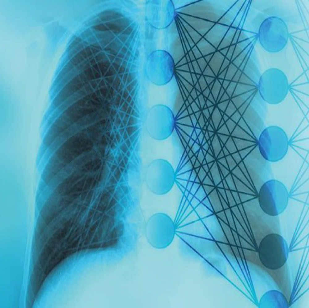 Pneumonia detection in XRay Images using Deep learning