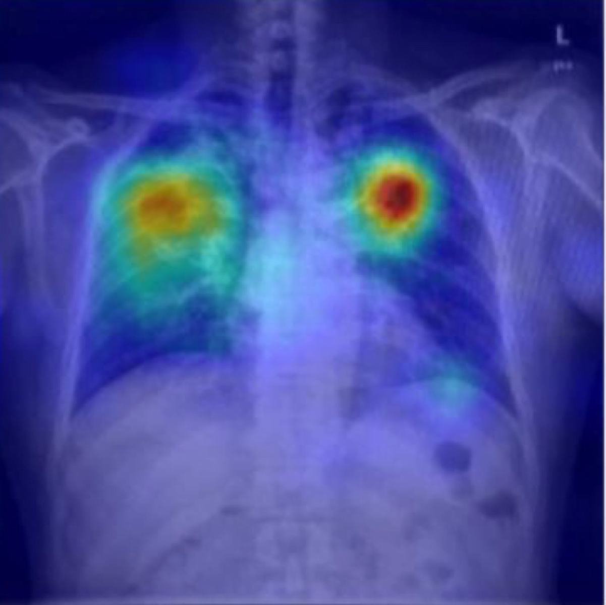 Tuberculosis Detection in XRAY Images using Matlab 1