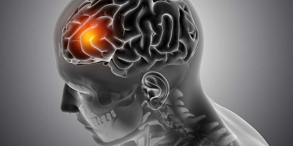 AI based Brain Tumour Detection using SWT based Image Fusion